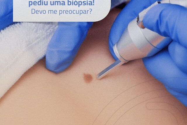 O dermatologista pediu uma biópsia! Devo me preocupar?