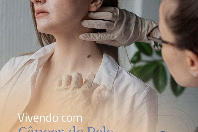 Vivendo com câncer de pele melanoma