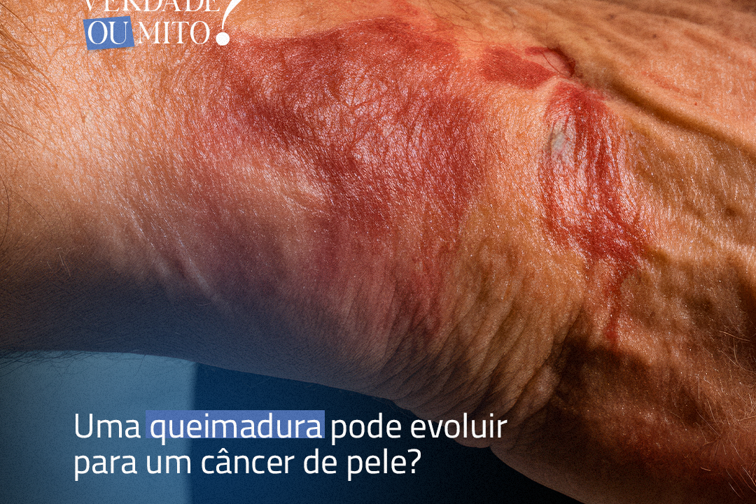 Uma Queimadura Pode Evoluir para um Câncer de Pele?